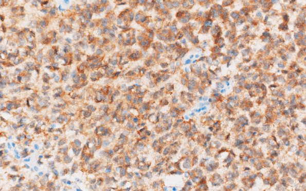 11B Oligodendroglioma, anaplastic (Case 11) IDH1 2