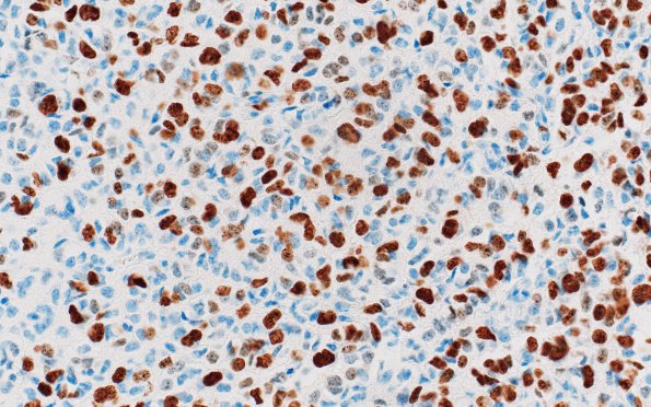 11C Oligodendroglioma, anaplastic (Case 11) Ki67 1