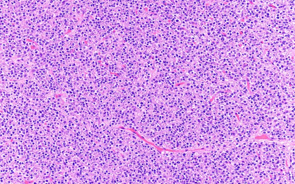 12A Oligodendroglioma, anaplastic (Case 12) H&E 3