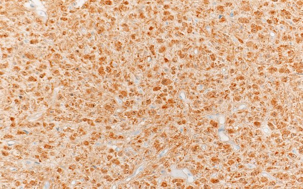 12B Oligodendroglioma, anaplastic (Case 12) IDH1 R132H 1