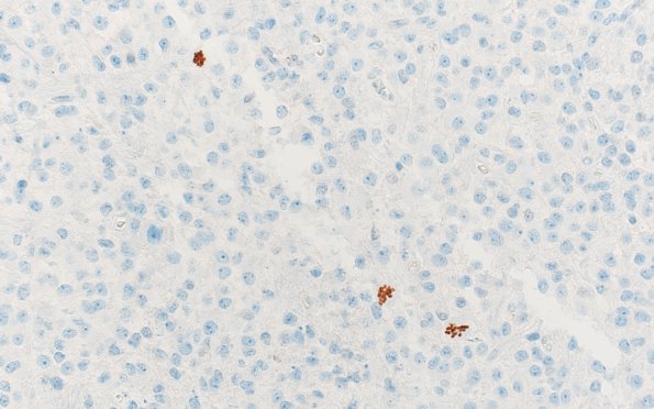 12C Oligodendroglioma, anaplastic (Case 12) PHH3 (poly) 1