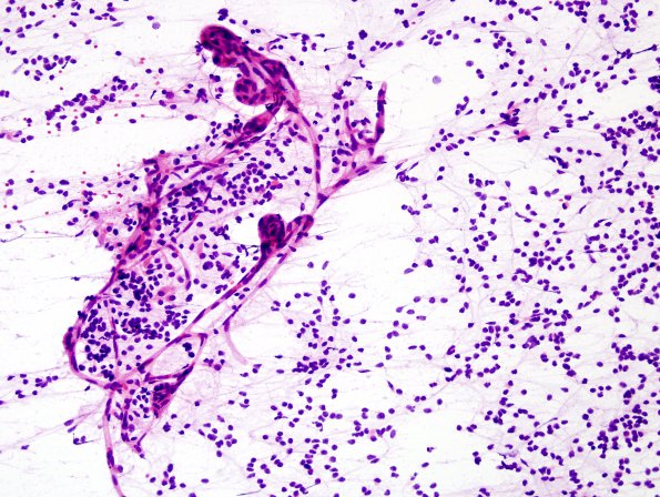 13A0 Oligodendroglioma, Gr3 (Case 13) H&E Smear 1