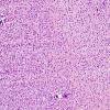 13A1 Oligodendroglioma, Gr3 (Case 13) H&E 2