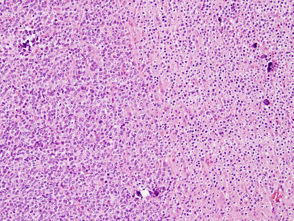 13A1 Oligodendroglioma, Gr3 (Case 13) H&E 2