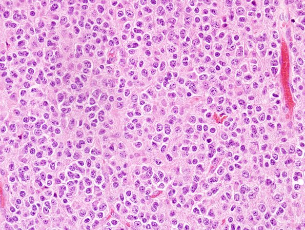 13A2 Oligodendroglioma, Gr3 (Case 13) H&E 4