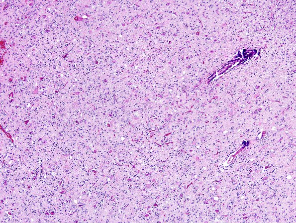 13A3 Oligodendroglioma, Gr3 (Case 13) H&E 11