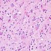 13A4 Oligodendroglioma, Gr3 (Case 13) H&E 10