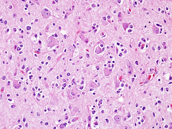 13A4 Oligodendroglioma, Gr3 (Case 13) H&E 10