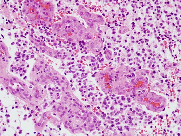 13A5 Oligodendroglioma, Gr3 (Case 13) H&E 8