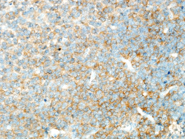 13B Oligodendroglioma, Gr3 (Case 13) IDH1 3