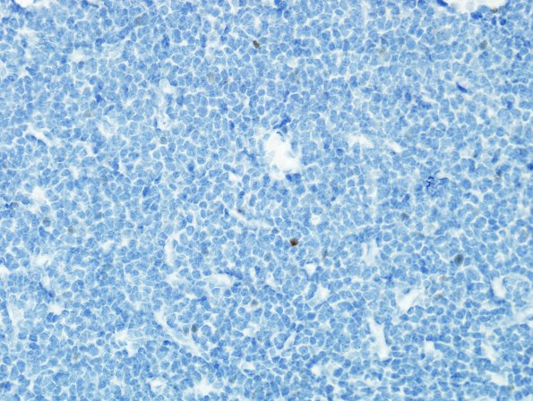 13C Oligodendroglioma, Gr3 (Case 13) P53