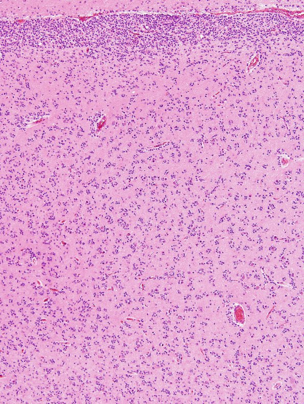 14A2 Oligodendroglioma, Gr3 (Case 14) H&E 1