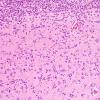 14A3 Oligodendroglioma, Gr3 (Case 14) H&E 2