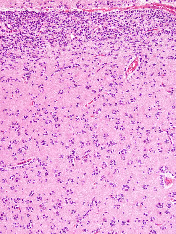 14A3 Oligodendroglioma, Gr3 (Case 14) H&E 2