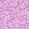 14A4 Oligodendroglioma, Gr3 (Case 14) H&E 14