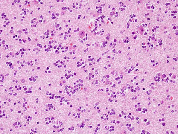 14A4 Oligodendroglioma, Gr3 (Case 14) H&E 14