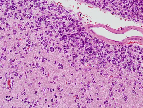 14A5 Oligodendroglioma, Gr3 (Case 14) H&E 13