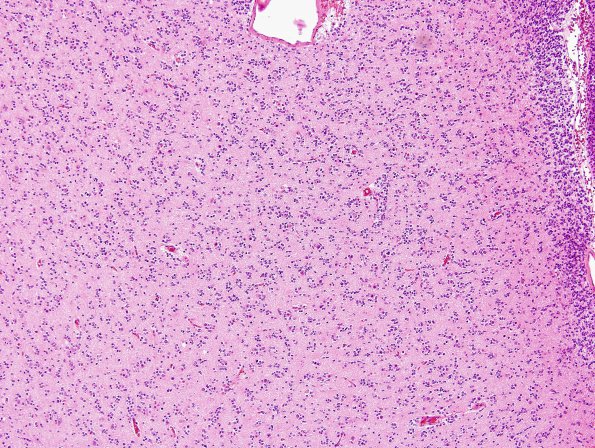 14A6 Oligodendroglioma, Gr3 (Case 14) H&E 15