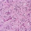 15A Oligodendroglioma, anaplastic (Case 15) b