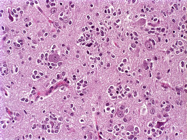 15A Oligodendroglioma, anaplastic (Case 15) b