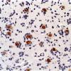 15B Oligodendroglioma, anaplastic (Case 15) NeuN b