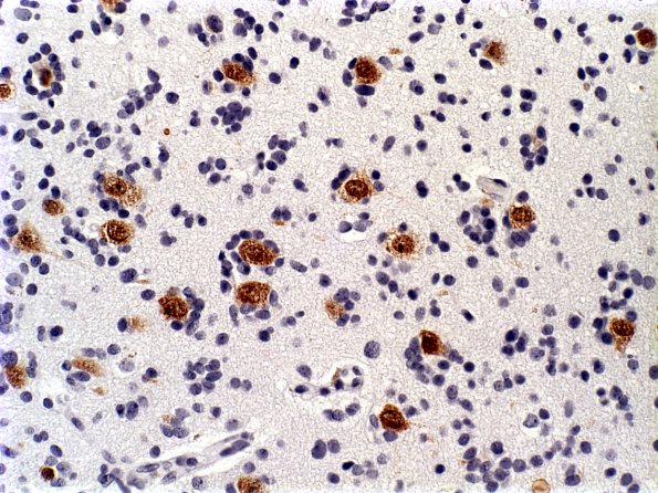 15B Oligodendroglioma, anaplastic (Case 15) NeuN b