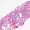 16A Oligodendroglioma, anaplastic, met (bone marrow) UAB (Case 16) H&E 1 (2)