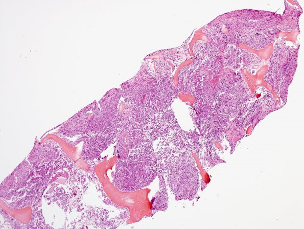 16A Oligodendroglioma, anaplastic, met (bone marrow) UAB (Case 16) H&E 1 (2)