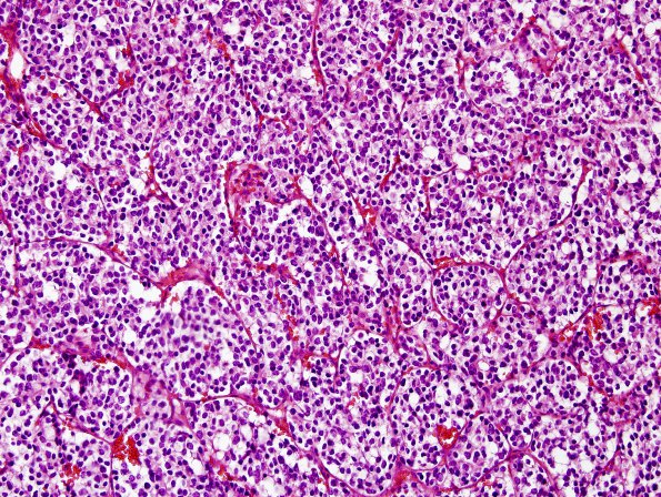 16A2 Oligodendroglioma, anaplastic, met (bone marrow) UAB (Case 16) H&E 1