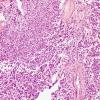 16A3 Oligodendroglioma, anaplastic, met (bone marrow) UAB (Case 16) H&E 2