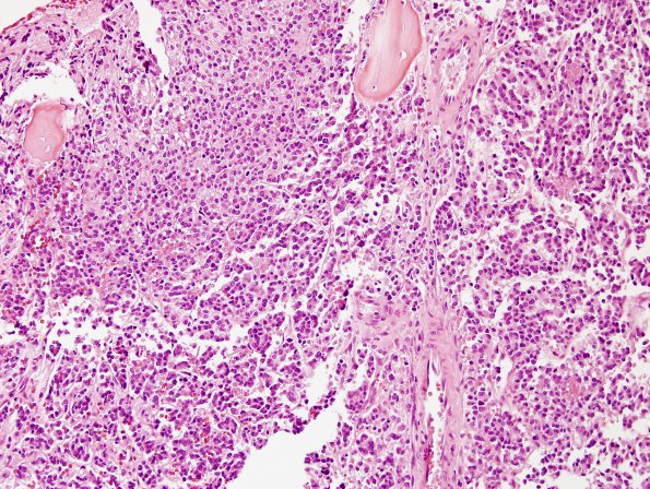 16A3 Oligodendroglioma, anaplastic, met (bone marrow) UAB (Case 16) H&E 2