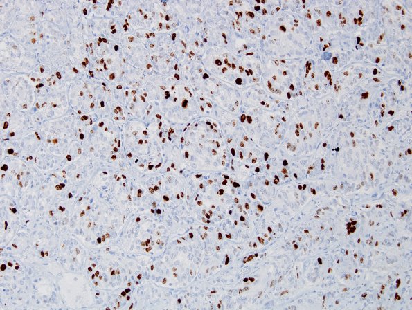 16C Oligodendroglioma, anaplastic, met (bone marrow) UAB (Case 16) Ki67 2