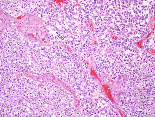 17A1 Oligodendroglioma, Gr3, 1p-9q del, small cell GBM mimic (Case 17) H&E 1