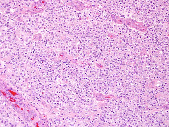 17A2 Oligodendroglioma, Gr3, 1p-9q del, small cell GBM mimic (Case 17) H&E 3