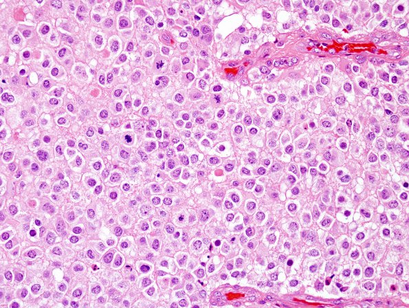 17A3 Oligodendroglioma, Gr3, 1p-9q del, small cell GBM mimic (Case 17) H&E 6