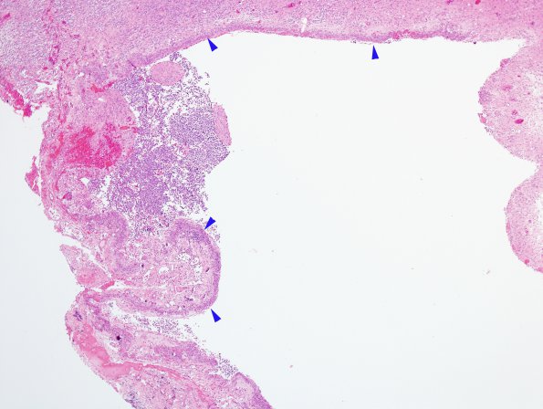 18A Oligodendroglioma, anaplastic, garlands (WHO III, Case 18) H&E 14 copy.jpg