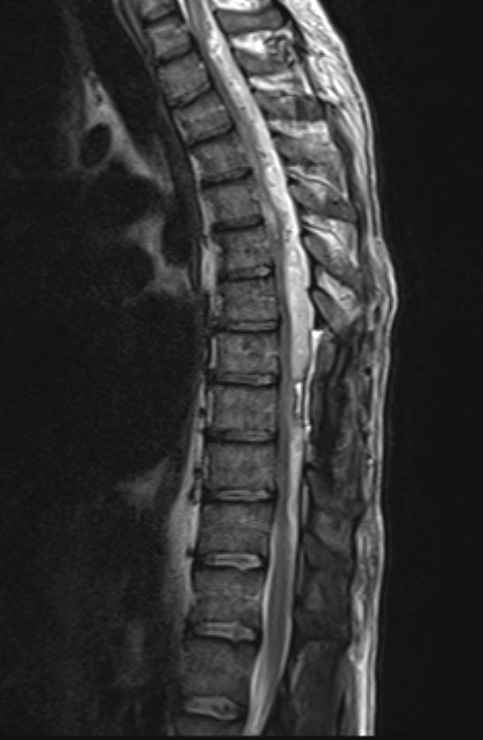 19A Oligodendroglioma, drop met extramural spinal (Case 19) T2 - Copy