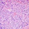 19B Oligodendroglioma, drop met extramural spinal (Case 19) H&E 4.jpg