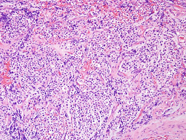 19B Oligodendroglioma, drop met extramural spinal (Case 19) H&E 4.jpg