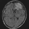 1A1 Oligodendroglioma, anaplastic Grade 3 (Case 1) FLAIR - Copy