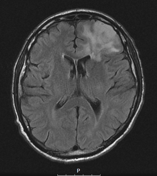 1A1 Oligodendroglioma, anaplastic Grade 3 (Case 1) FLAIR - Copy