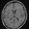 1A2 Oligodendroglioma, anaplastic Grade 3 (Case 1) T1noC - Copy