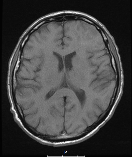 1A2 Oligodendroglioma, anaplastic Grade 3 (Case 1) T1noC - Copy