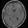 1A3 Oligodendroglioma, anaplastic Grade 3 (Case 1) T1W - Copy