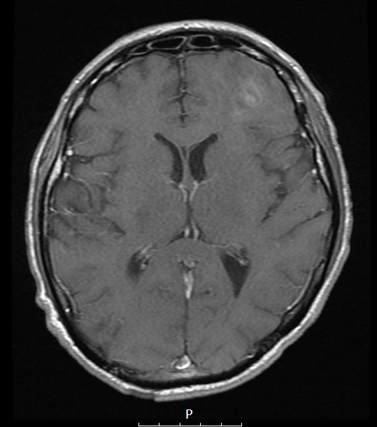 1A3 Oligodendroglioma, anaplastic Grade 3 (Case 1) T1W - Copy