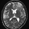 1A4 Oligodendroglioma, anaplastic Grade 3 (Case 1) T2W - Copy