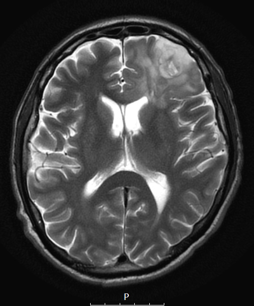 1A4 Oligodendroglioma, anaplastic Grade 3 (Case 1) T2W - Copy