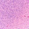 1B2 Oligodendroglioma, anaplastic Grade 3 (Case 1) H&E 20X