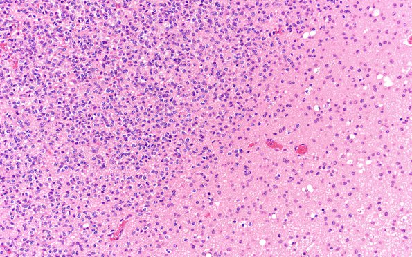 1B2 Oligodendroglioma, anaplastic Grade 3 (Case 1) H&E 20X