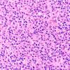 1B3 Oligodendroglioma, anaplastic Grade 3 (Case 1) H&E 40X